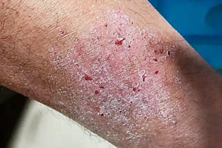 干性湿疹小腿脱皮图