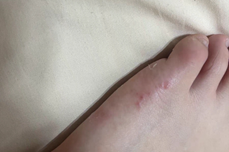 水疱型足癣脚侧面有水疱图