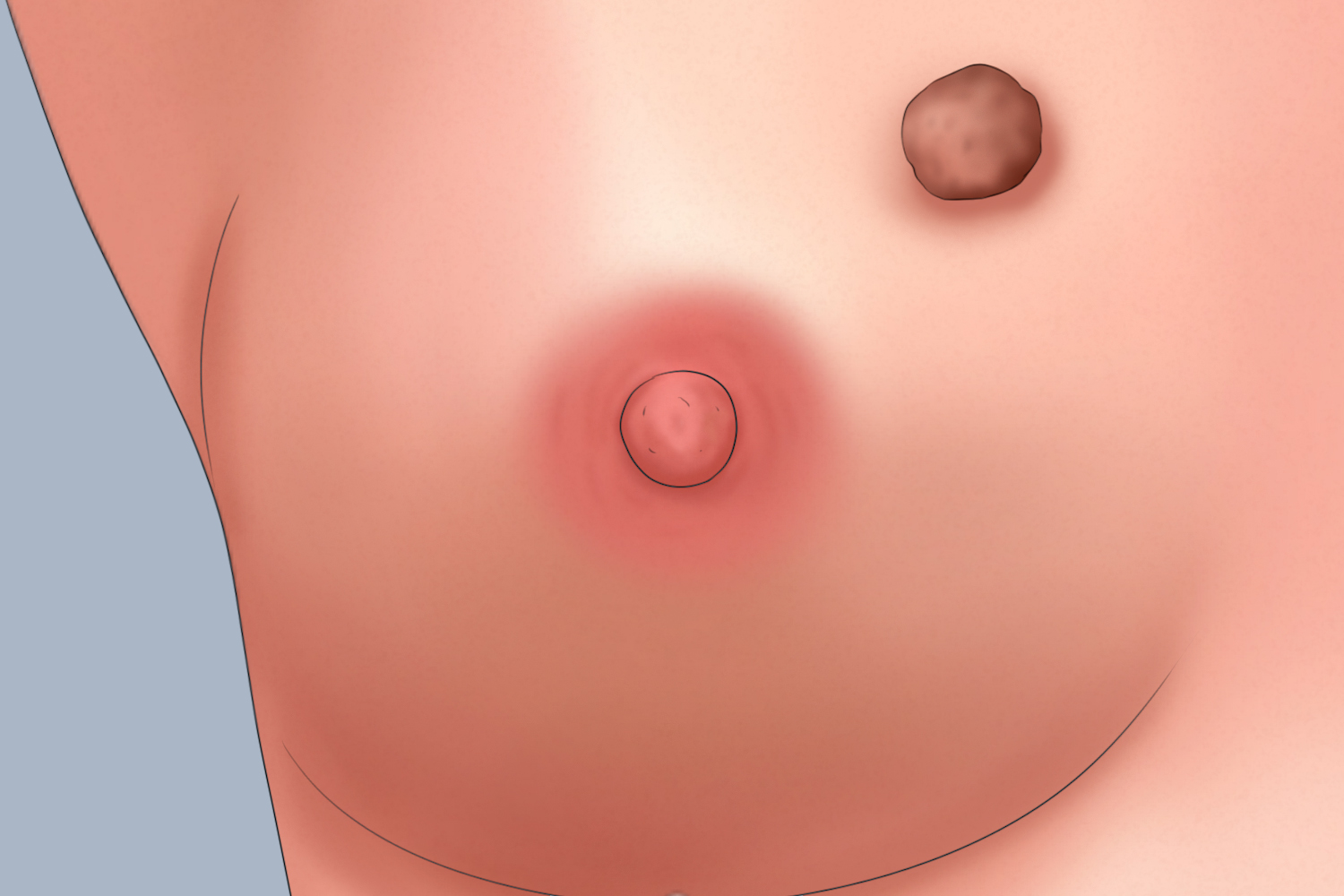 乳房周围的寻常疣图