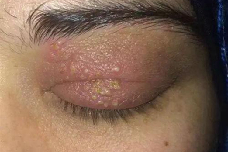 单纯疱疹性角膜炎眼睑小水疱图 单纯疱疹性角膜炎眼睑小水疱图