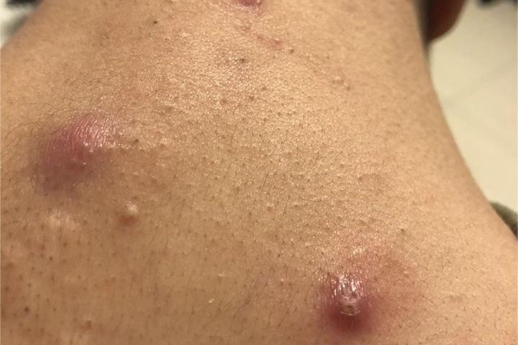 聚合性痤疮背部大包图