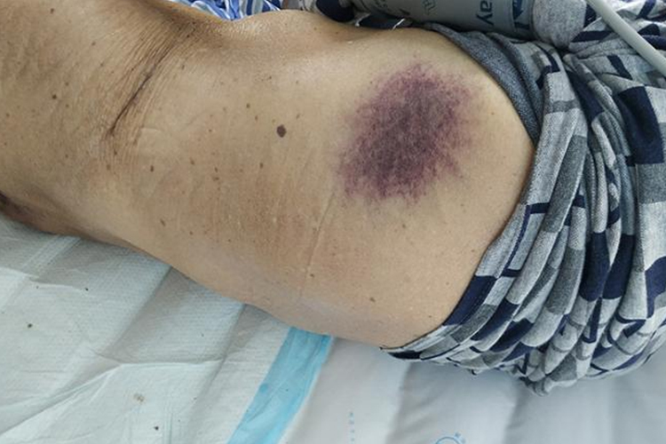 血癌的症状及图片