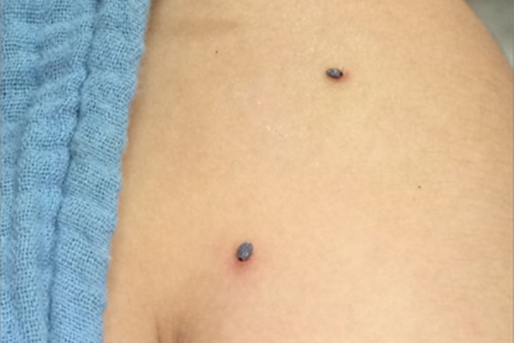 蜱咬伤肩部有结痂图