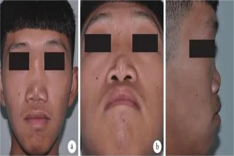 Binder综合征症状图 Binder综合征症状图