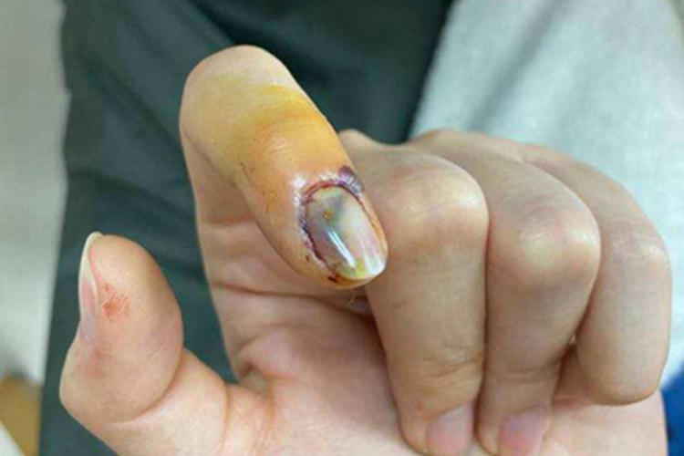 甲床炎食指指甲出血发黑图