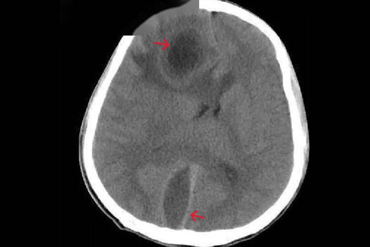 脑脓肿CT增强扫描环形增强图