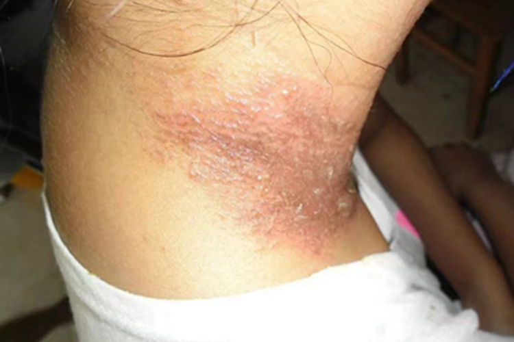 急性接触性皮炎侧颈红斑图