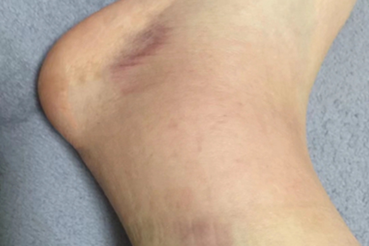 踝扭伤脚踝红肿发紫图 踝扭伤脚踝红肿发紫图