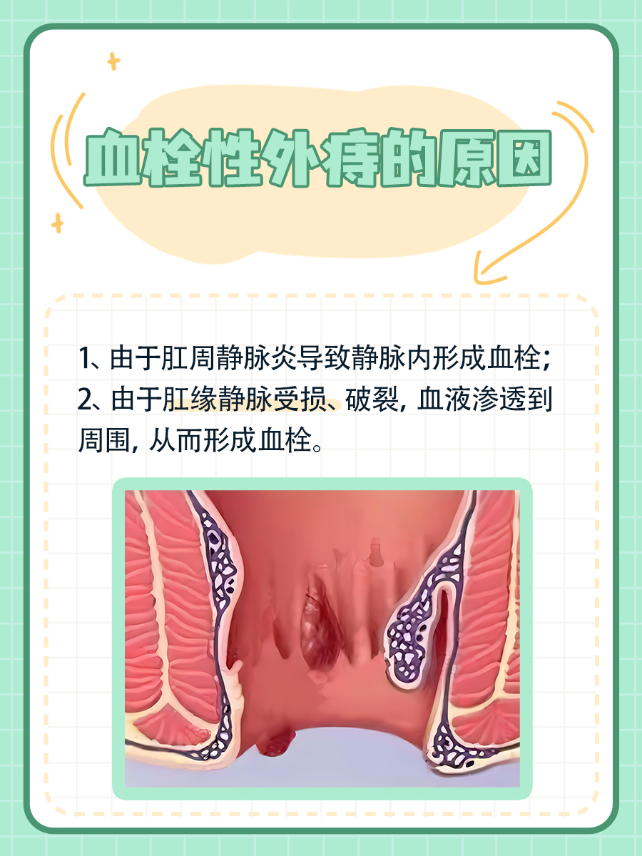 如何摆脱肛周“紫葡萄”——血栓性外痔