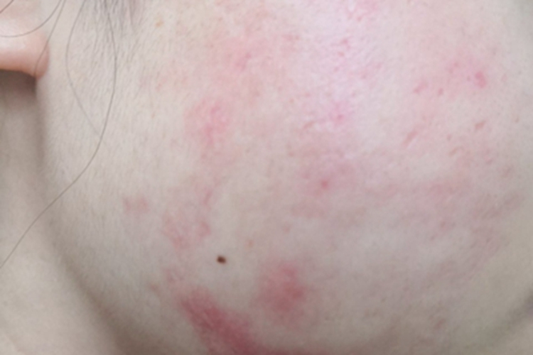 硬结性红斑面部症状图