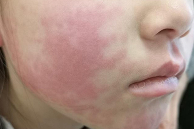 过敏性皮炎小孩脸上长红斑块图