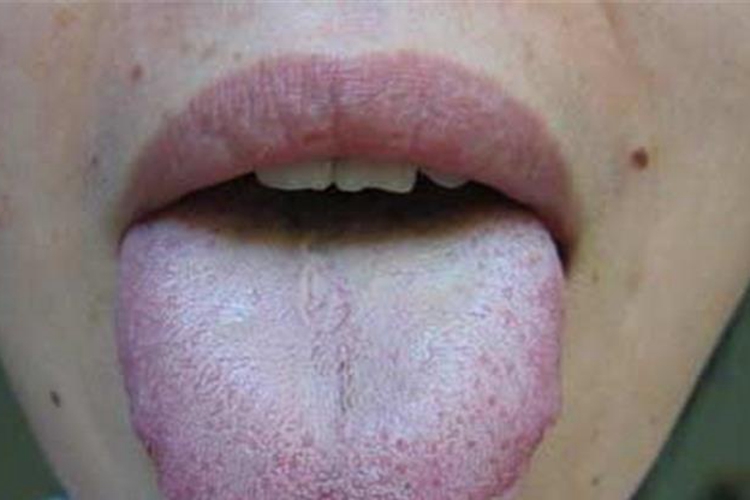 苔白厚腻病在胃、肺图 苔白厚腻病在胃、肺图