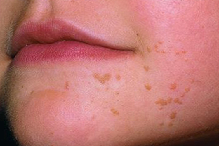 扁平疣口周斑图