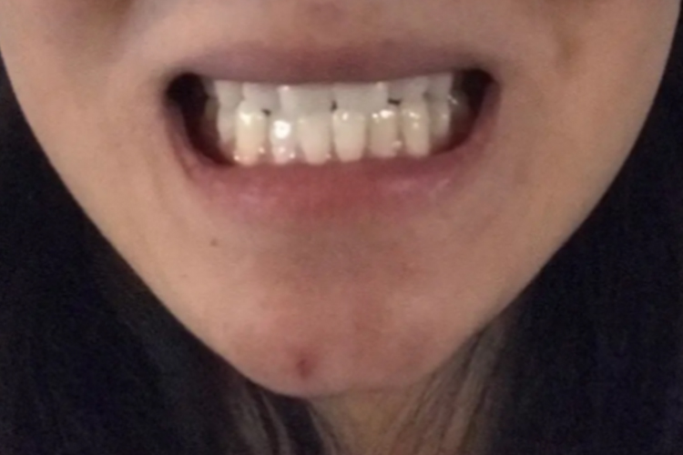 轻微前牙反(牙合)图