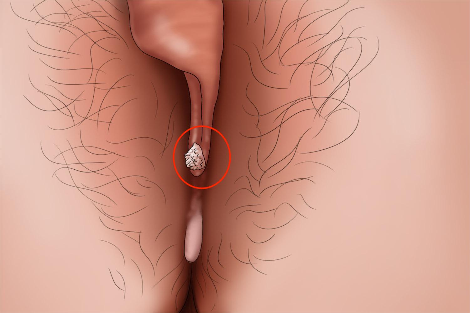 外阴尖锐湿疣会阴部疙瘩手绘图