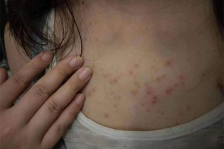 湿疹型多形性日光疹红斑图