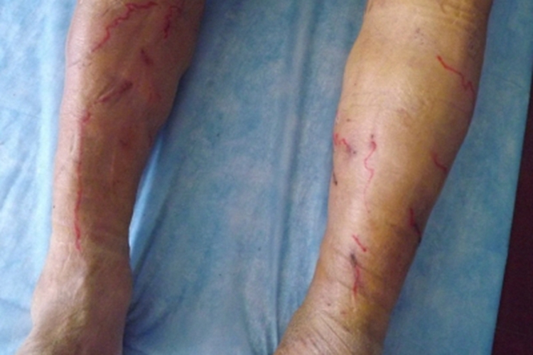 四肢血栓性浅静脉炎小腿条纹图