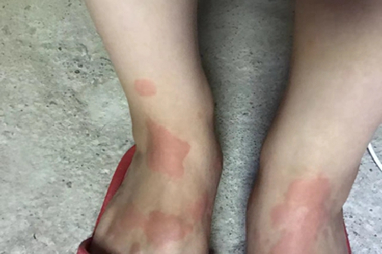 荨麻疹脚背症状图