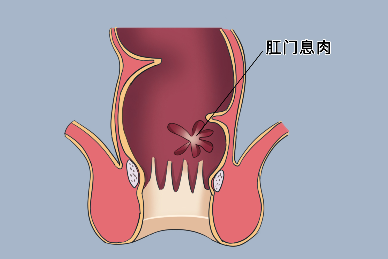 肛门息肉有什么症状图片