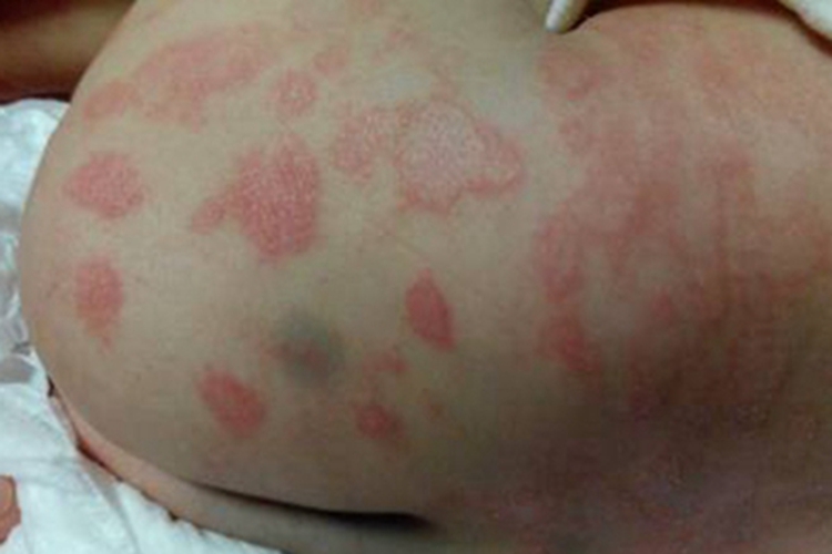 光线性痒疹臀部红斑图