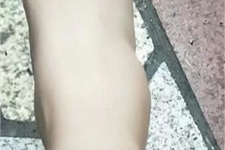 踝扭伤脚踝局部肿的突起来图