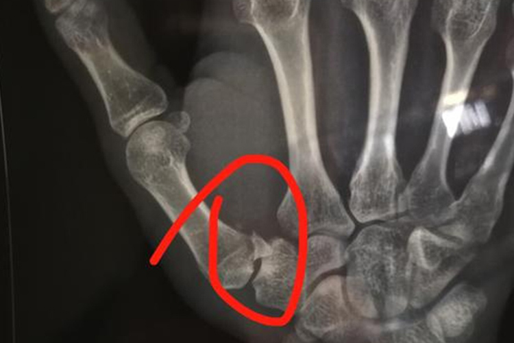 第1掌骨骨折X线检查图