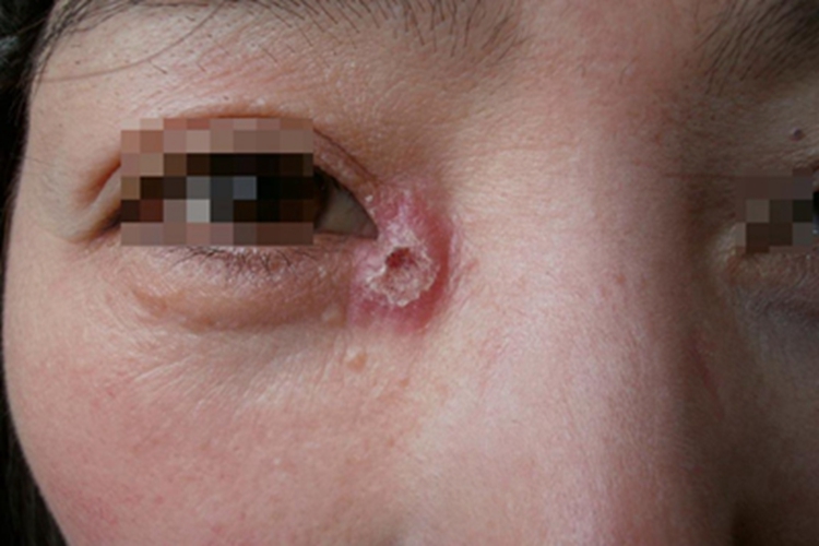 播散型皮肤型孢子丝菌病结节图