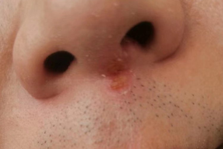 单纯疱疹鼻部结痂图