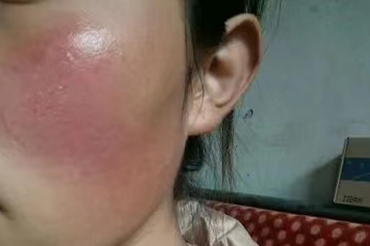 晒伤后皮肤发红图