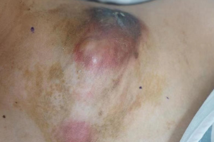 锁骨软骨肉瘤图