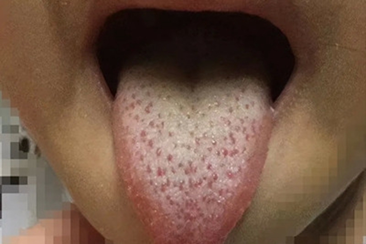 普通型猩红热舌头红点图 普通型猩红热舌头红点图