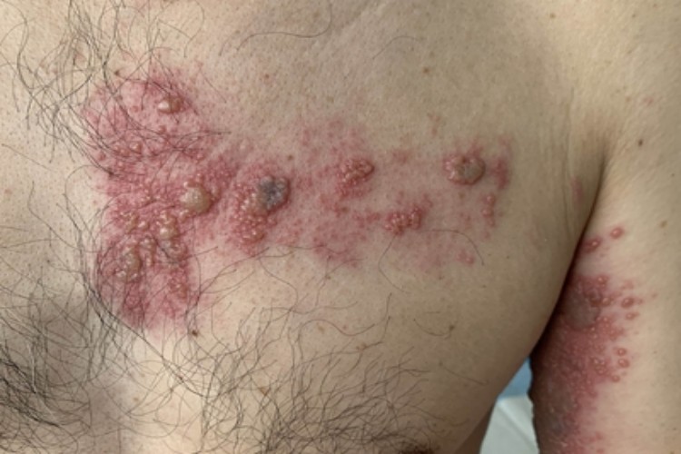 带状疱疹胸部水疱图