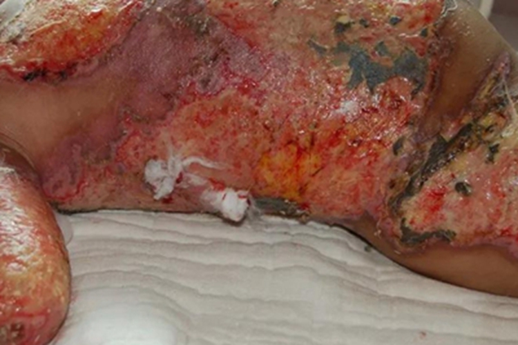 三度烫伤全身症状图