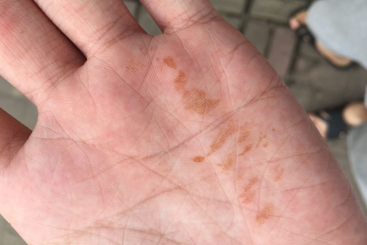 手掌突然长锈黄斑图片