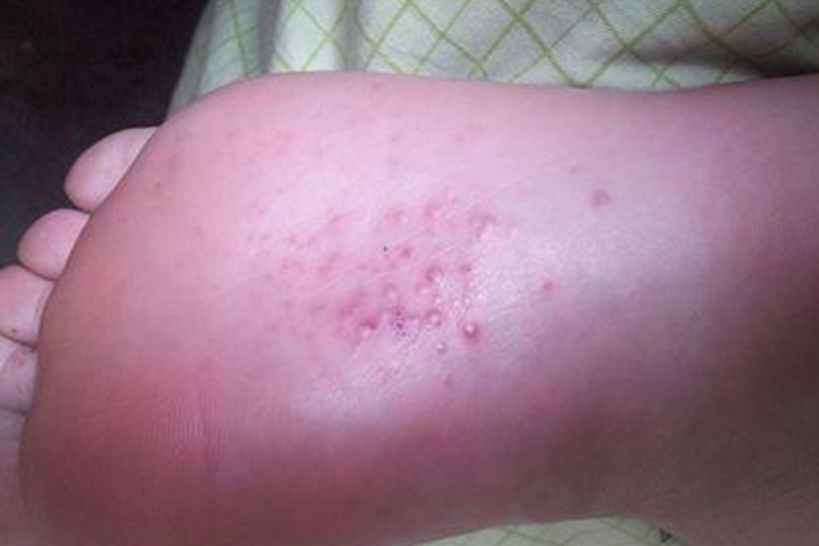 掌心水疱型足癣图