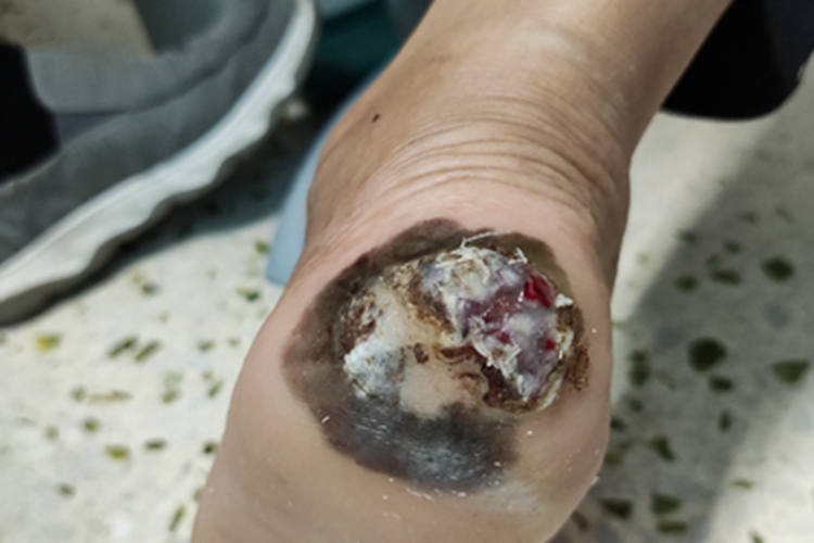 浅表播散型黑色素瘤脚后跟糜烂图