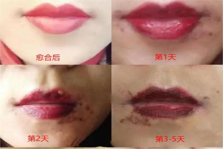 半永久唇前期恢复过程图