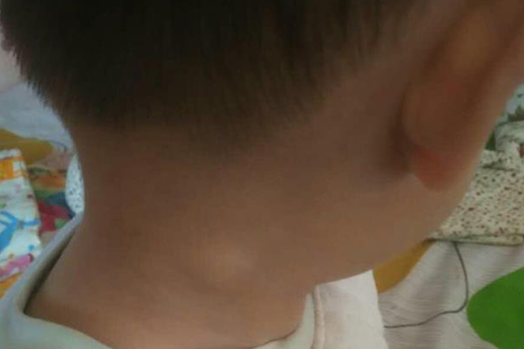 颈部淋巴结肿大图