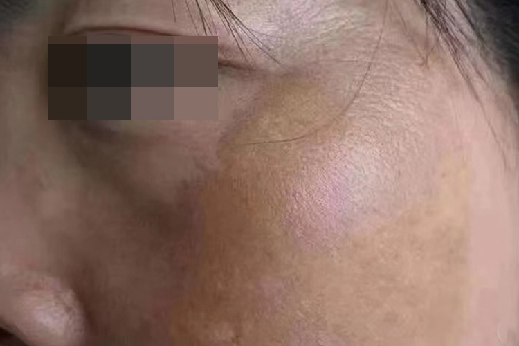 黄褐斑图 黄褐斑图