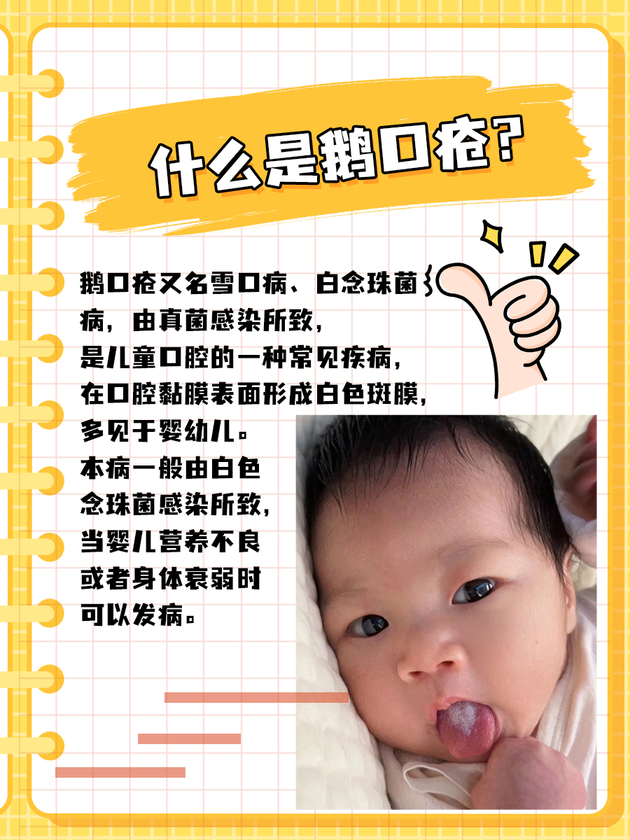 宝妈进！宝宝嘴里“擦不掉的奶渍”是鹅口疮吗？