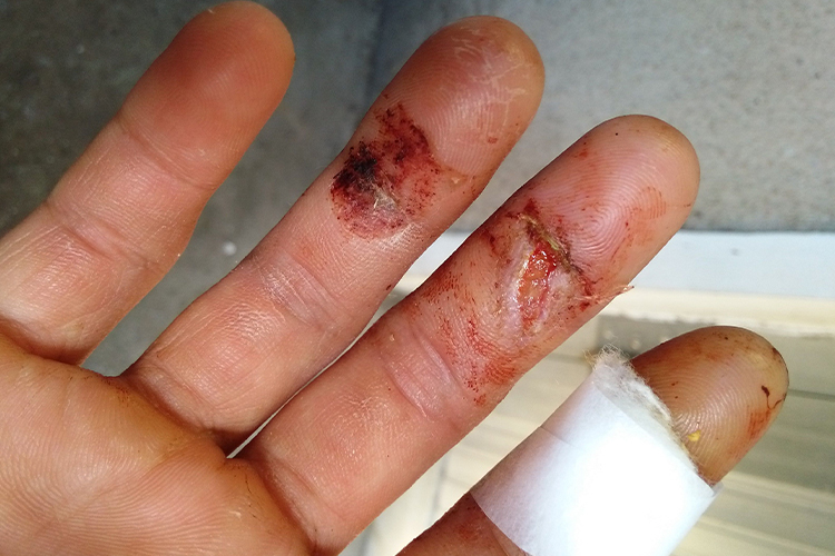 中指切伤有小伤口图 中指切伤有小伤口图