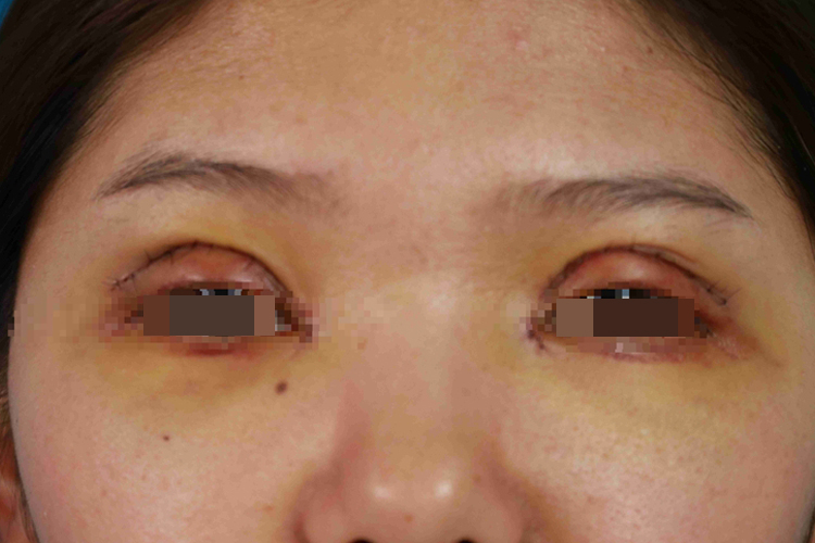 重睑术肿样图 重睑术肿样图