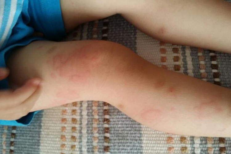 荨麻疹宝宝腿上一片一片红图