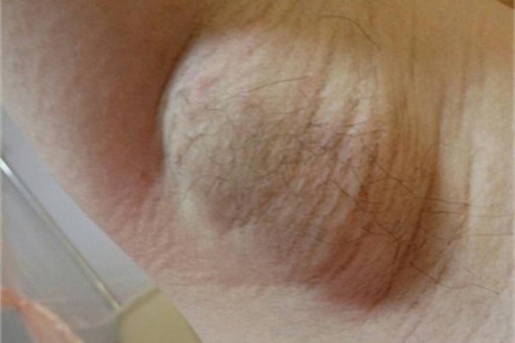 艾滋病腋窝症状图