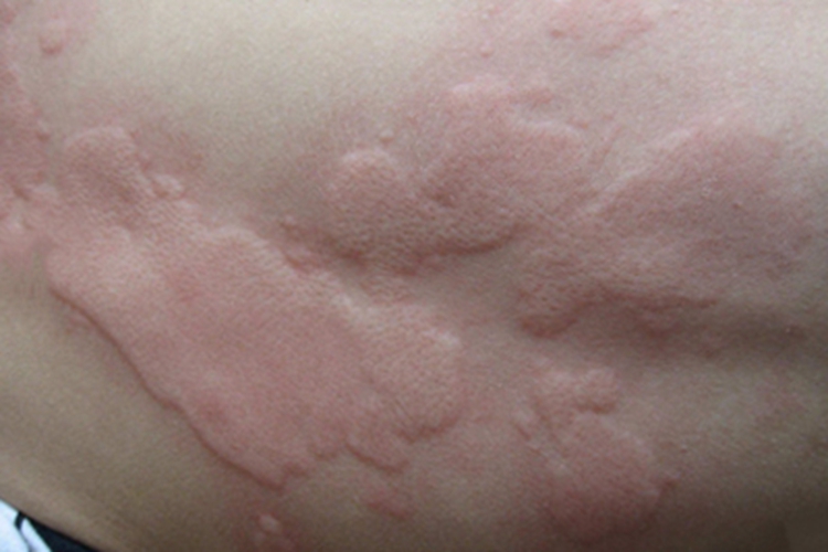 海水浴者皮疹背部症状图 海水浴者皮疹背部症状图