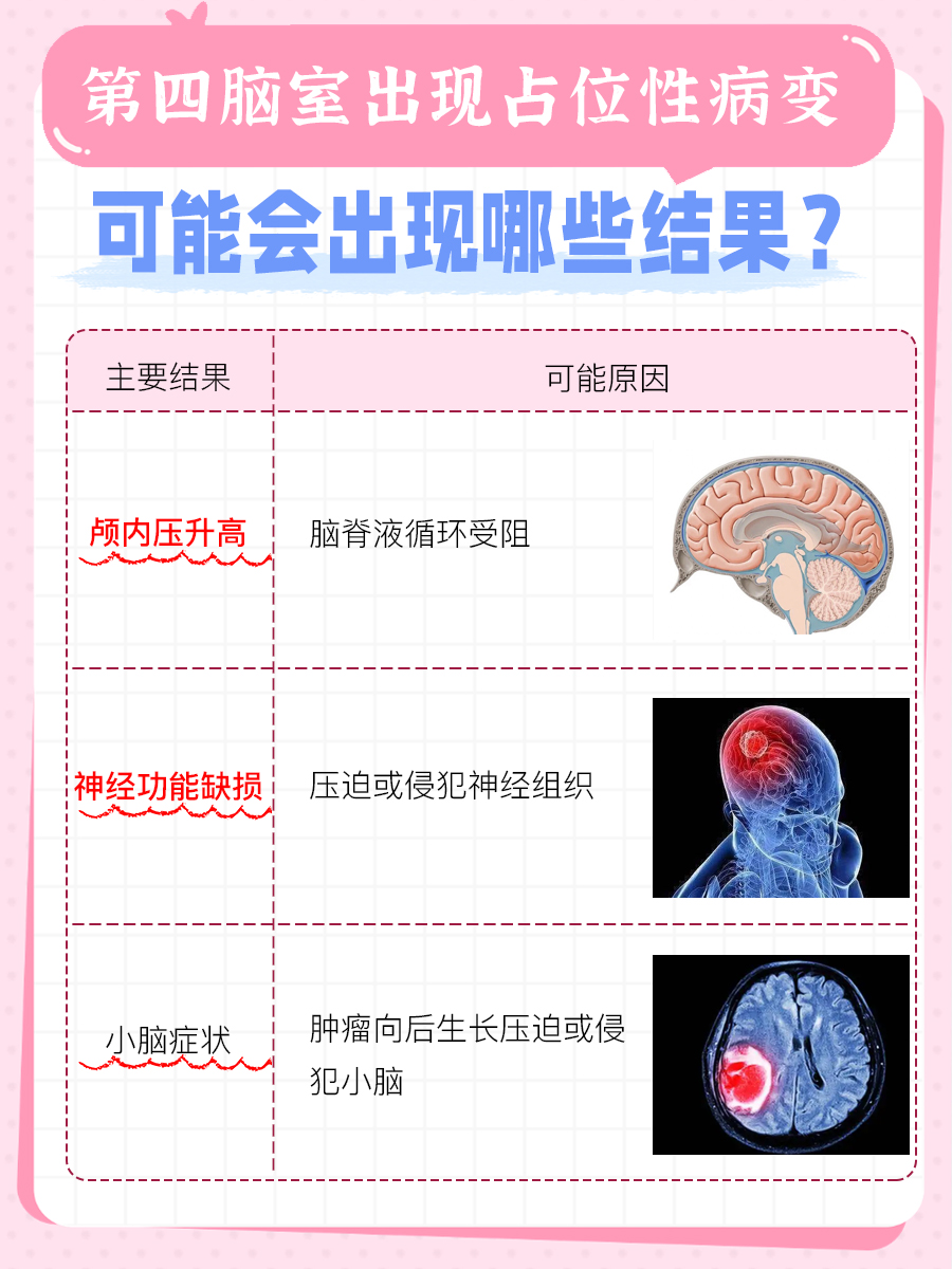 四脑室占位病变：了解可能的结果