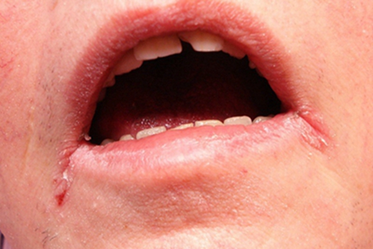 口角炎口周症状图