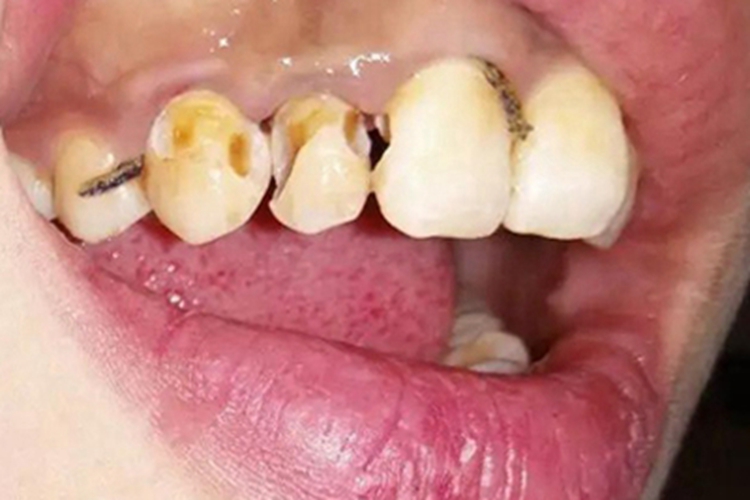 酸蚀症牙齿缺损不整齐图