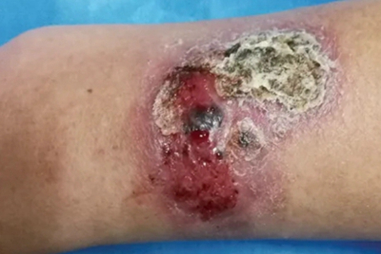 皮肤非典型分枝杆菌病胳膊溃疡图 皮肤非典型分枝杆菌病胳膊溃疡图
