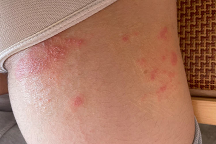 接触性皮炎大腿红点图